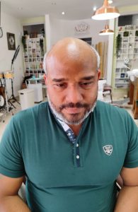 protesis-capilar-marbella-sir-franklin-monasterios-